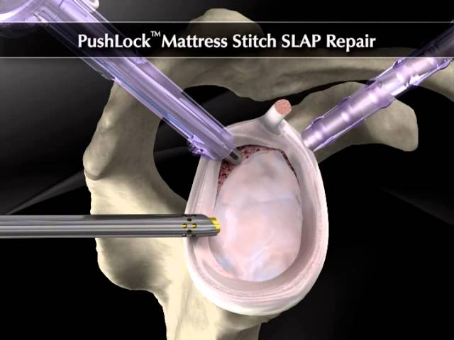 Arthrex PushLock® Mattress Stitch SLAP Repair - YouTube