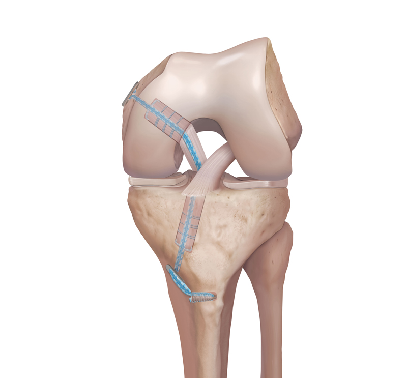 Internal Brace in depth - the knee - Mackay Clinic