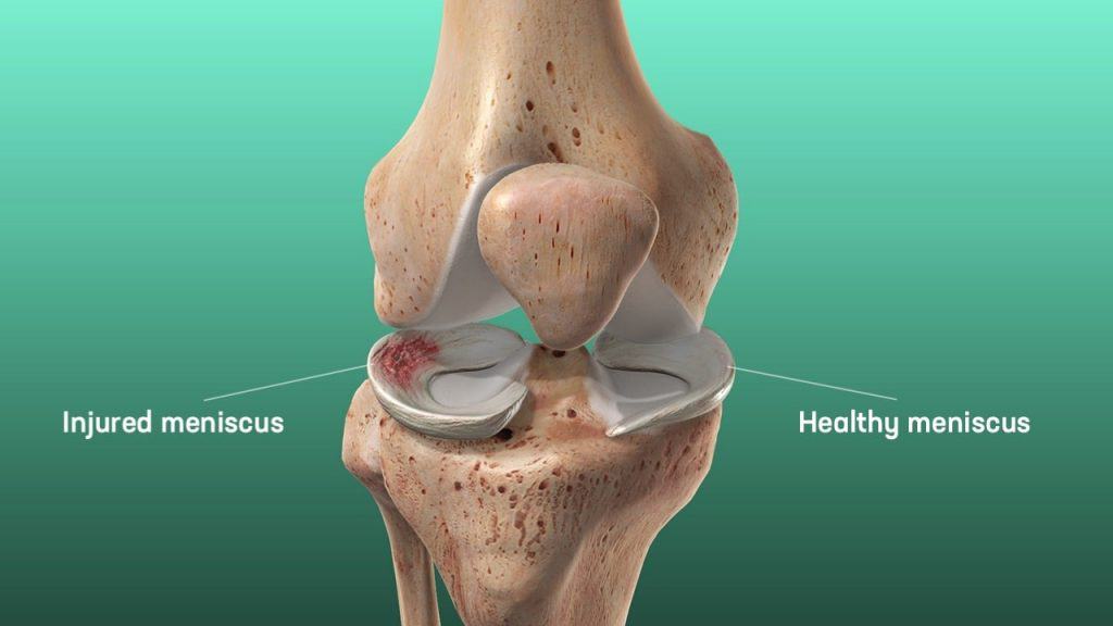 mensicus tear vs healthy meniscus