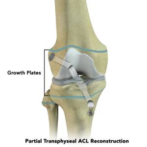 Partial Transphyseal Surgery Boston | ACL Reconstruction Surgery Atlanta, San Diego, New York City