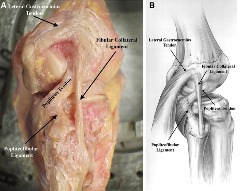 Posterolateral Corner Injury - Knee &amp; Sports - Orthobullets