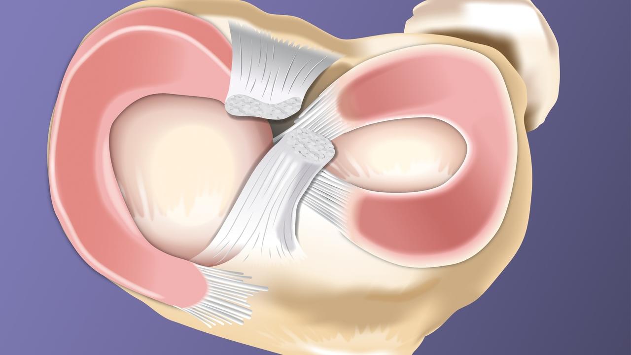 What Is a Torn Meniscus