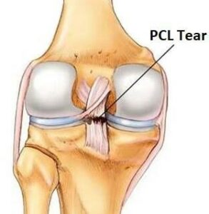 PCL Tear